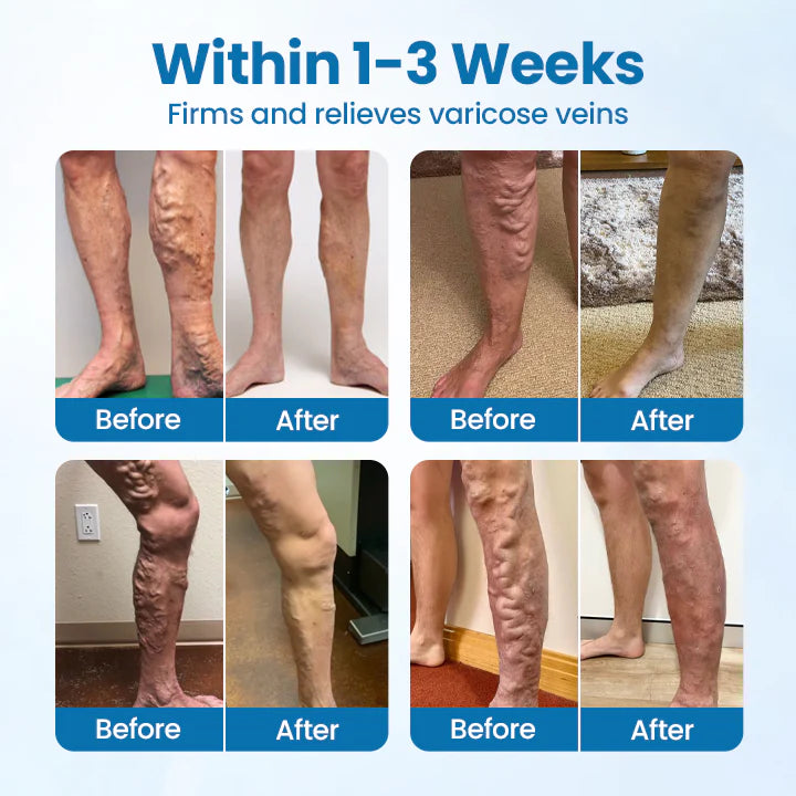 NESLEMY® VeinGuard Herbal Spray-✅ Clinically proven to eliminate varicose veins in just 7 days!