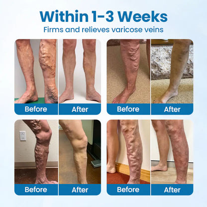 NESLEMY® VeinGuard Herbal Spray-✅ Clinically proven to eliminate varicose veins in just 7 days!
